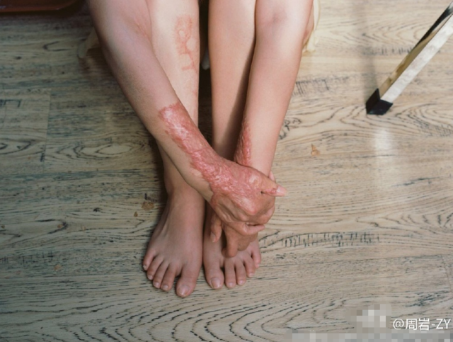 Mutige Frau zeigt ihre Brandwunden